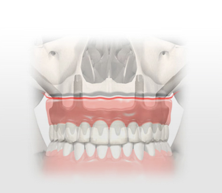 Zygomatic Implants